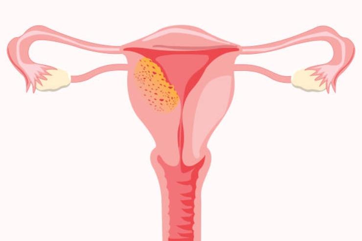 Adenomyosis