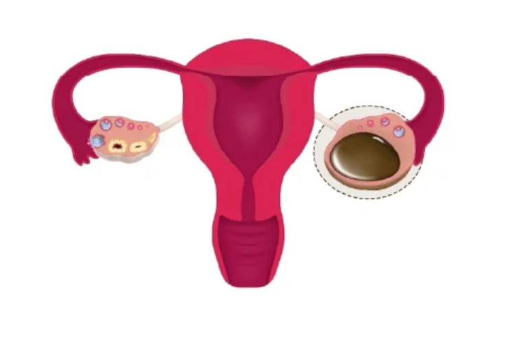 CA Endometrium Surgery----14