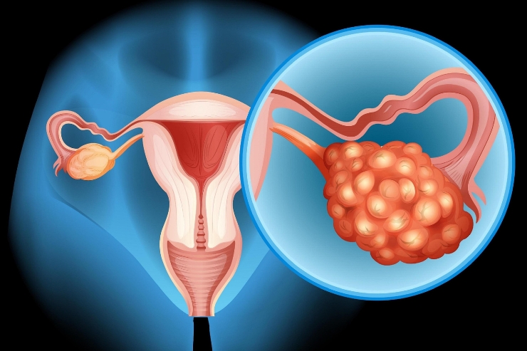 CA Ovary Surgery-----14