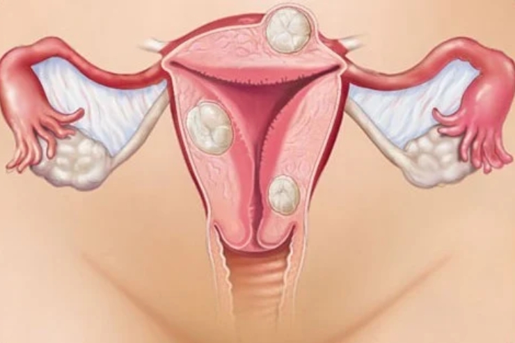 Endometriosis Surgery-----14