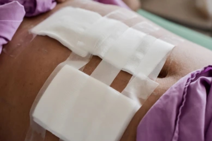 Laparoscopic Myomectomy------14