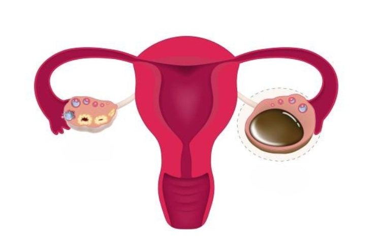Ovarian Cysts