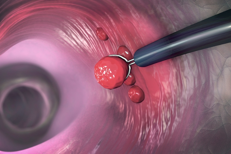 Paramectomy Surgery----14